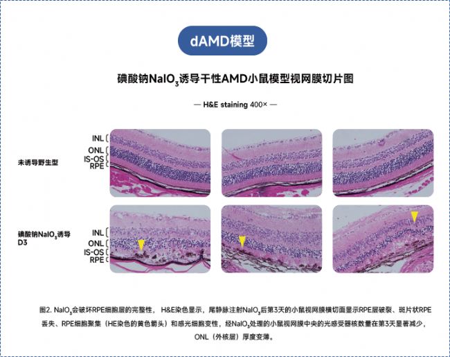 年齡相關(guān)性黃斑變性