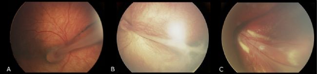 家族性滲出性玻璃體視網(wǎng)膜病變