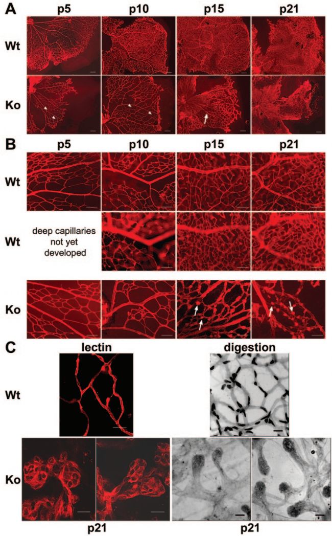 家族性滲出性玻璃體視網(wǎng)膜病變