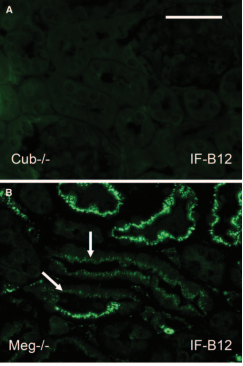 維生素B12選擇性 吸收障礙綜合征