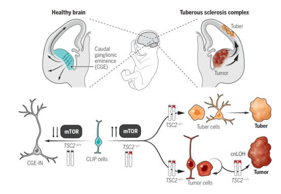 結(jié)節(jié)性硬化癥