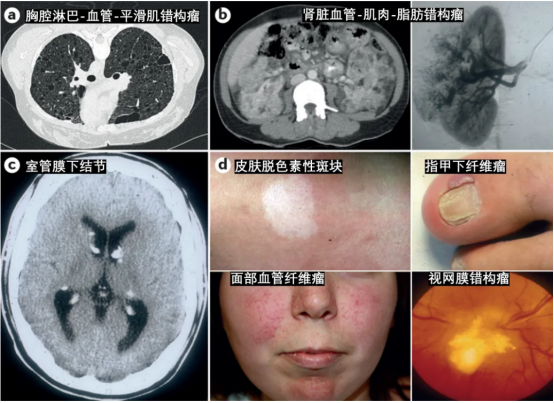 結(jié)節(jié)性硬化癥