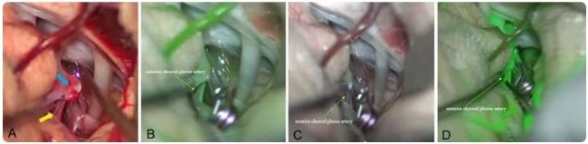 顯微課堂 | 動(dòng)脈瘤夾閉:使用 AR 熒光實(shí)時(shí)評(píng)估穿支血管